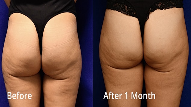 Body transformation comparison: before and after.