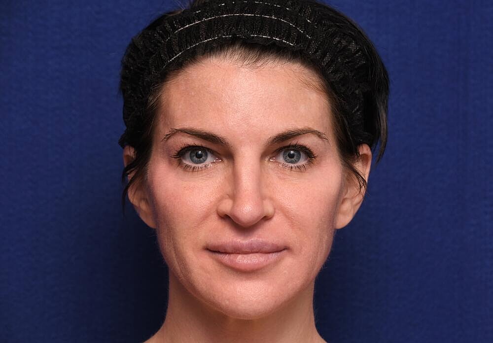 Injectable Brow Lift Before & After