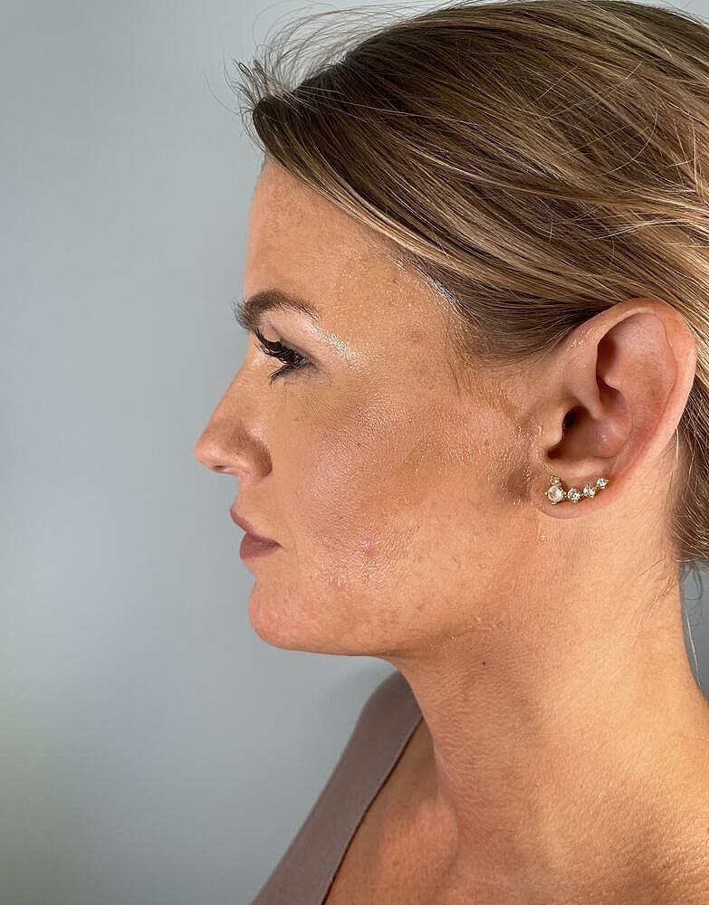 Jawline Conntouring Before & After