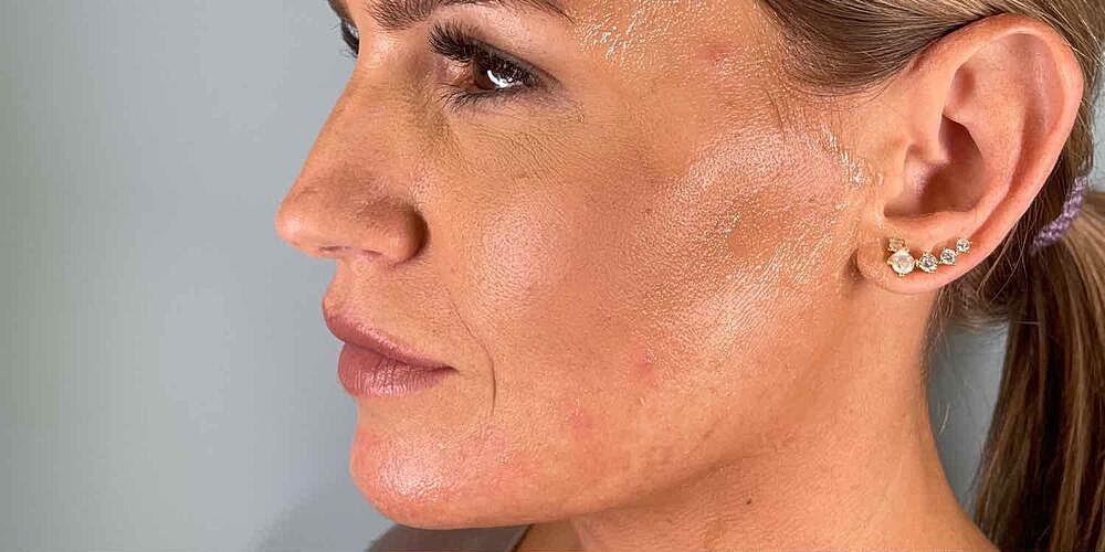 Jawline Conntouring Before & After