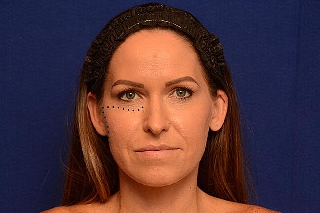 Radiesse Injections Before & After