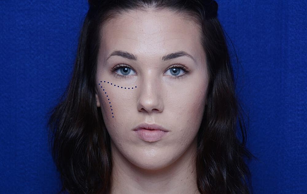 Radiesse Injections Before & After