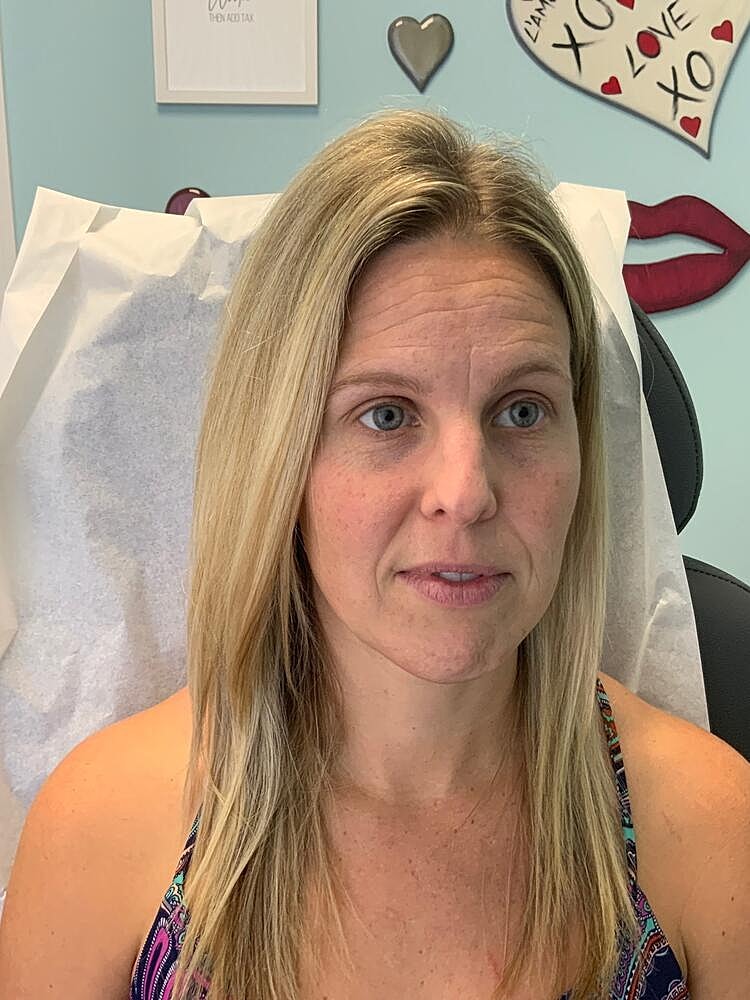 Wrinkle Reduction Before & After