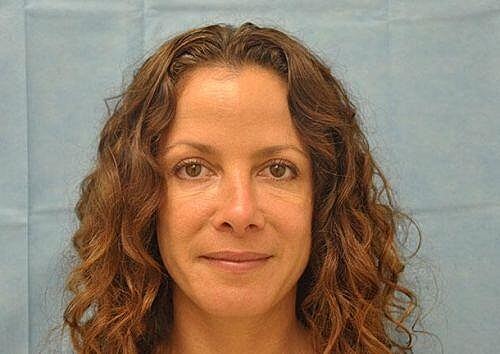 Botox Before & After