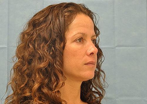 Botox Before & After