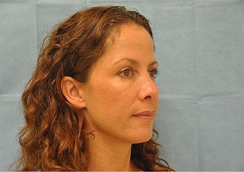 Botox Before & After