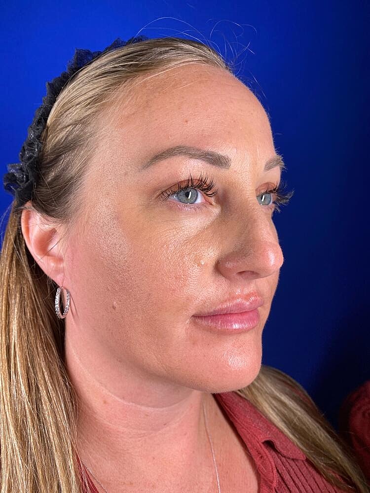 Lip Augmentation Before & After