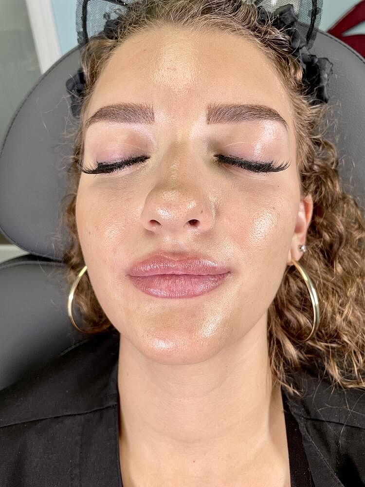 Lip Augmentation Before & After