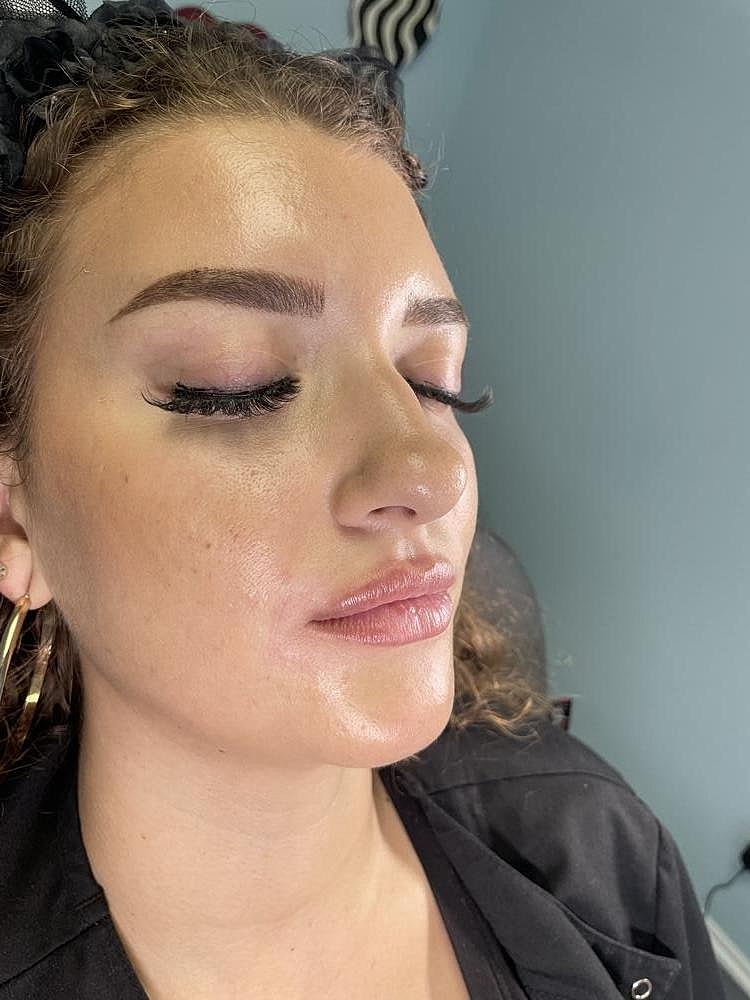 Lip Augmentation Before & After