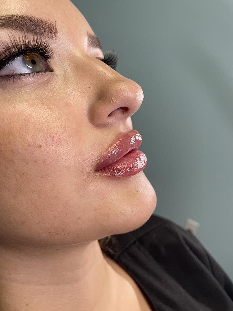 Lip Augmentation Before & After