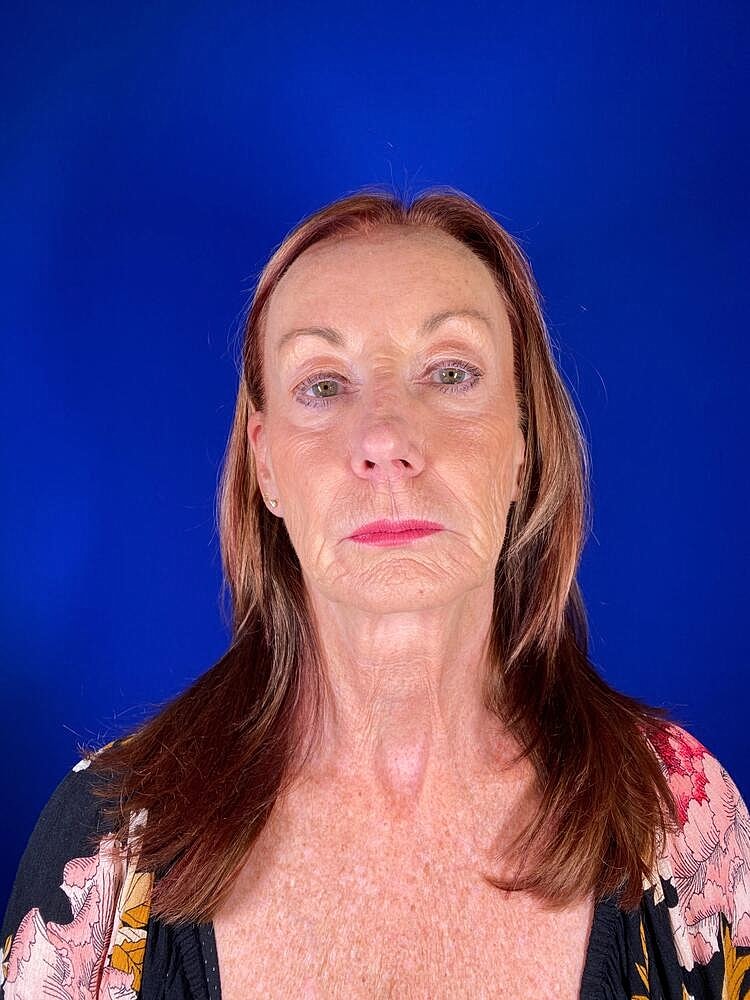 Renuva Before & After