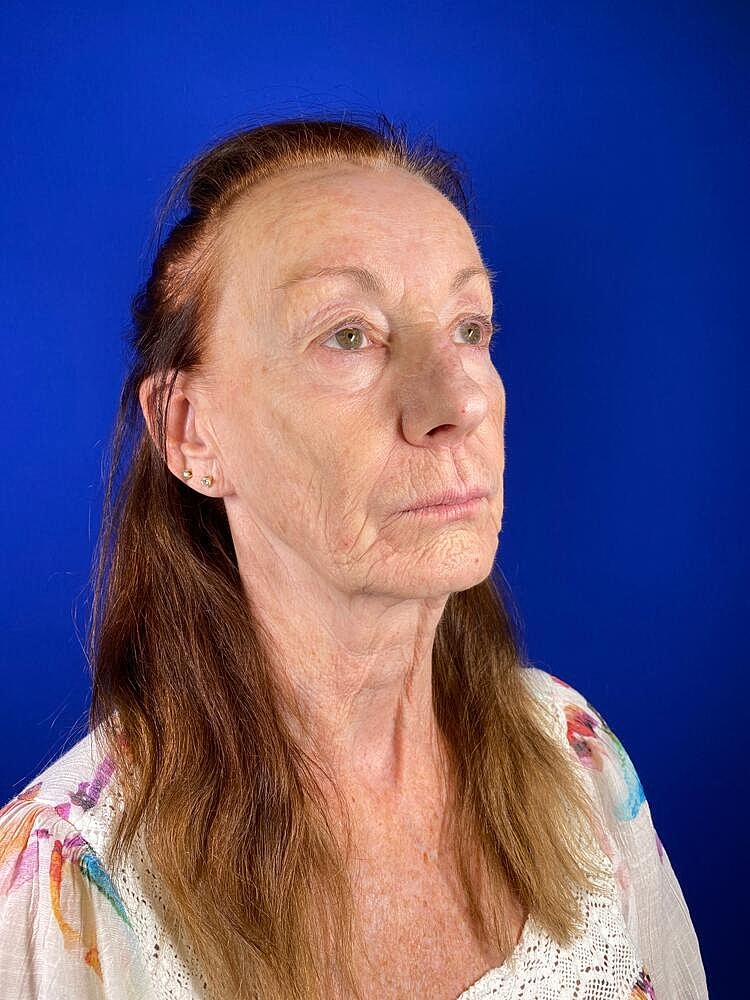 Renuva Before & After