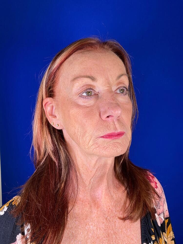 Renuva Before & After