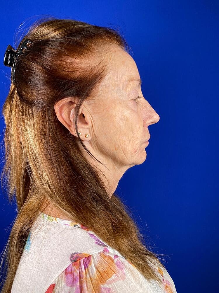 Renuva Before & After