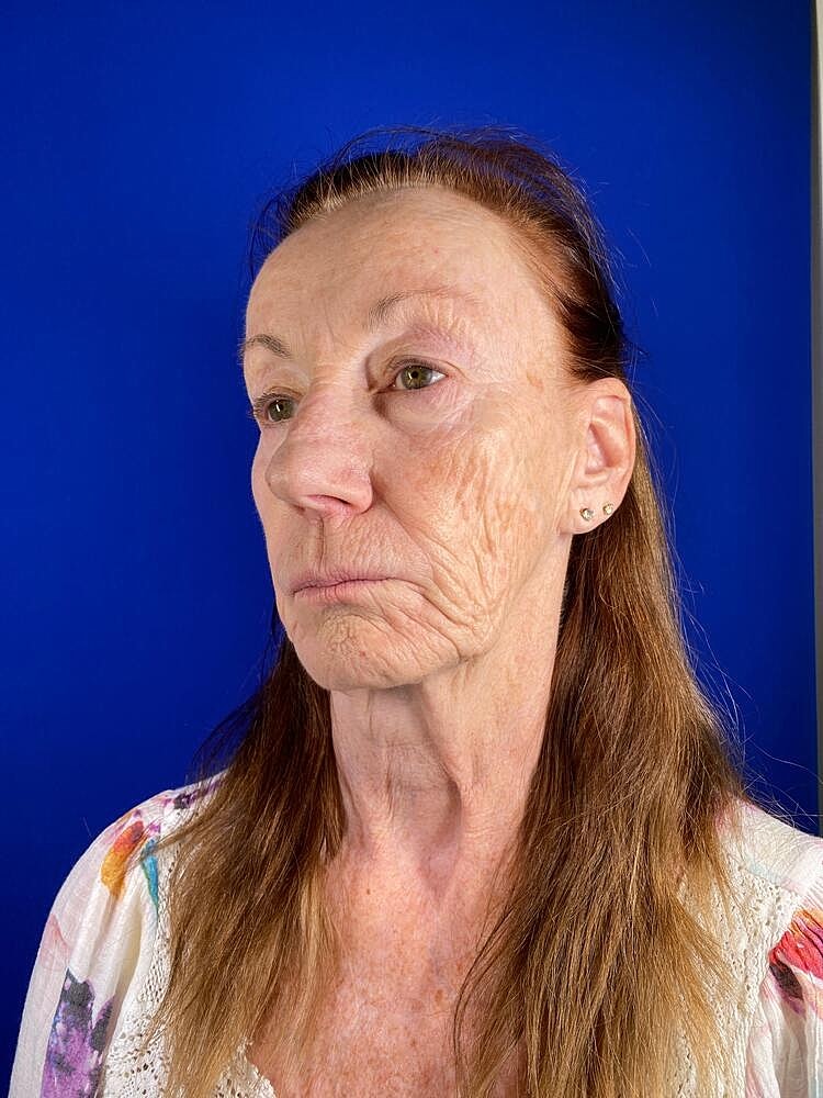 Renuva Before & After