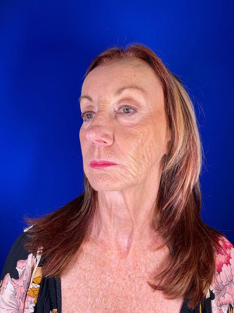 Renuva Before & After