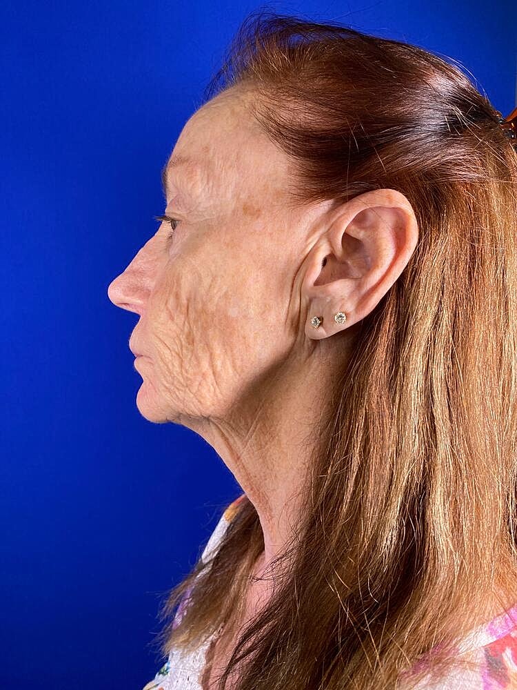 Renuva Before & After