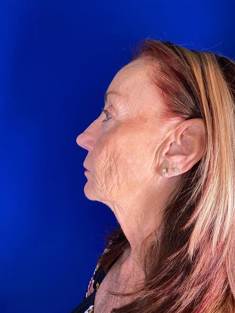 Renuva Before & After