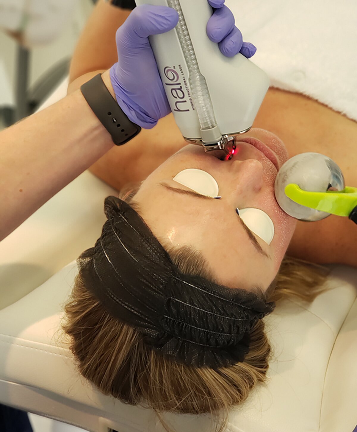 Vero Beach laser skin resurfacing patient receiving treatment