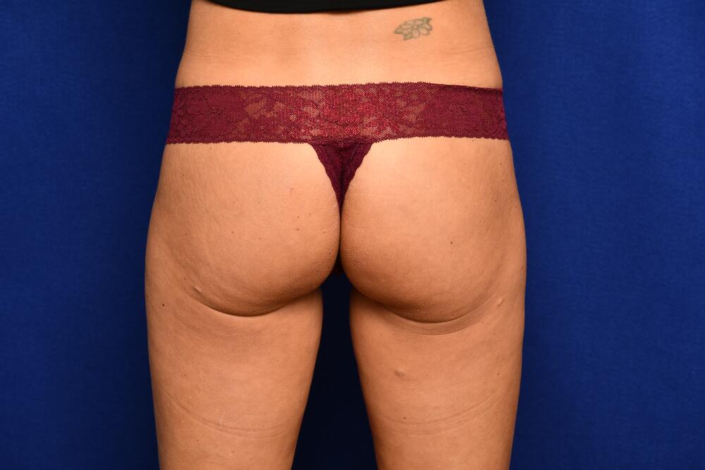 Injectable Butt Lift Before & After Image