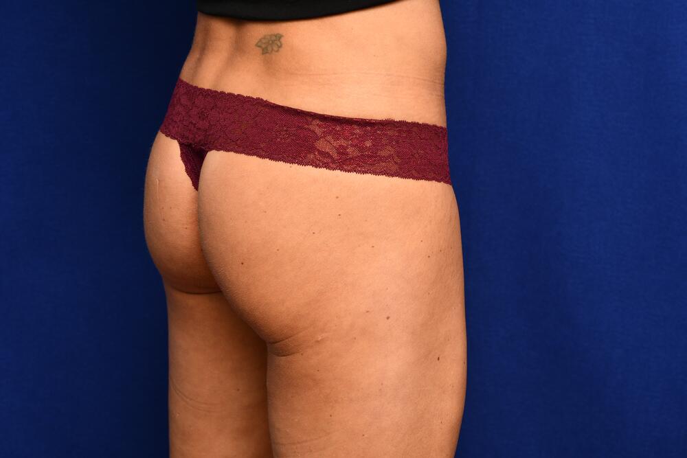 Injectable Butt Lift Before & After Image