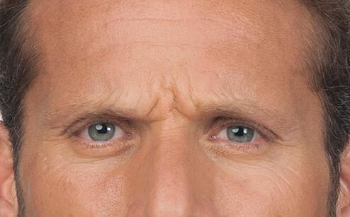 BOTOX® for men Before & After Image