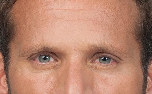 BOTOX® for men Before & After Image