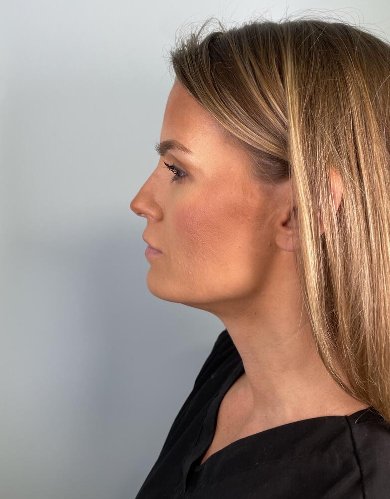 Jawline Contouring Before & After Image