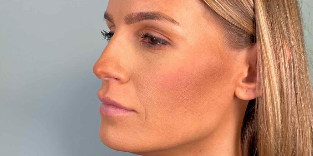 Jawline Contouring Before & After Image